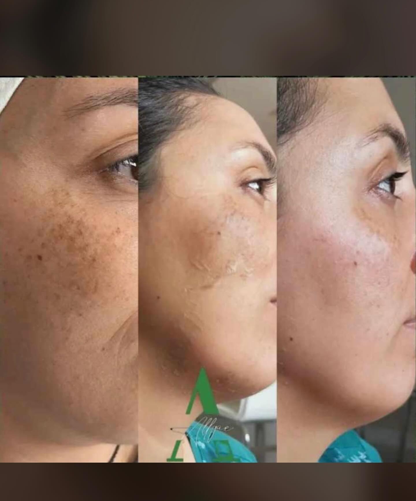 Hydrafacial vs Classic Skincare: Antalya Comparison