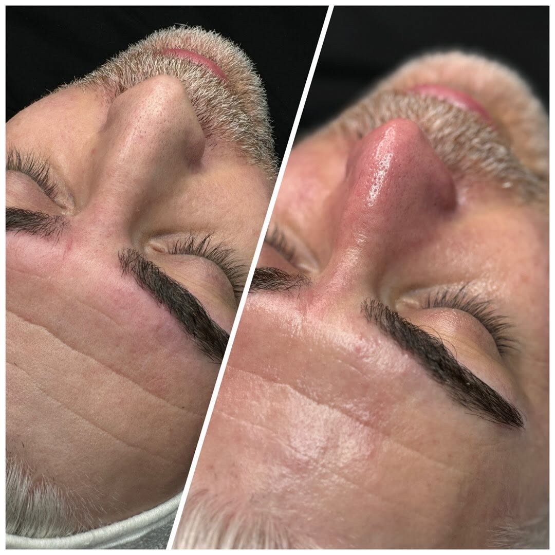Laser Hair Removal Prices in Kepez: Factors That Affect Pricing