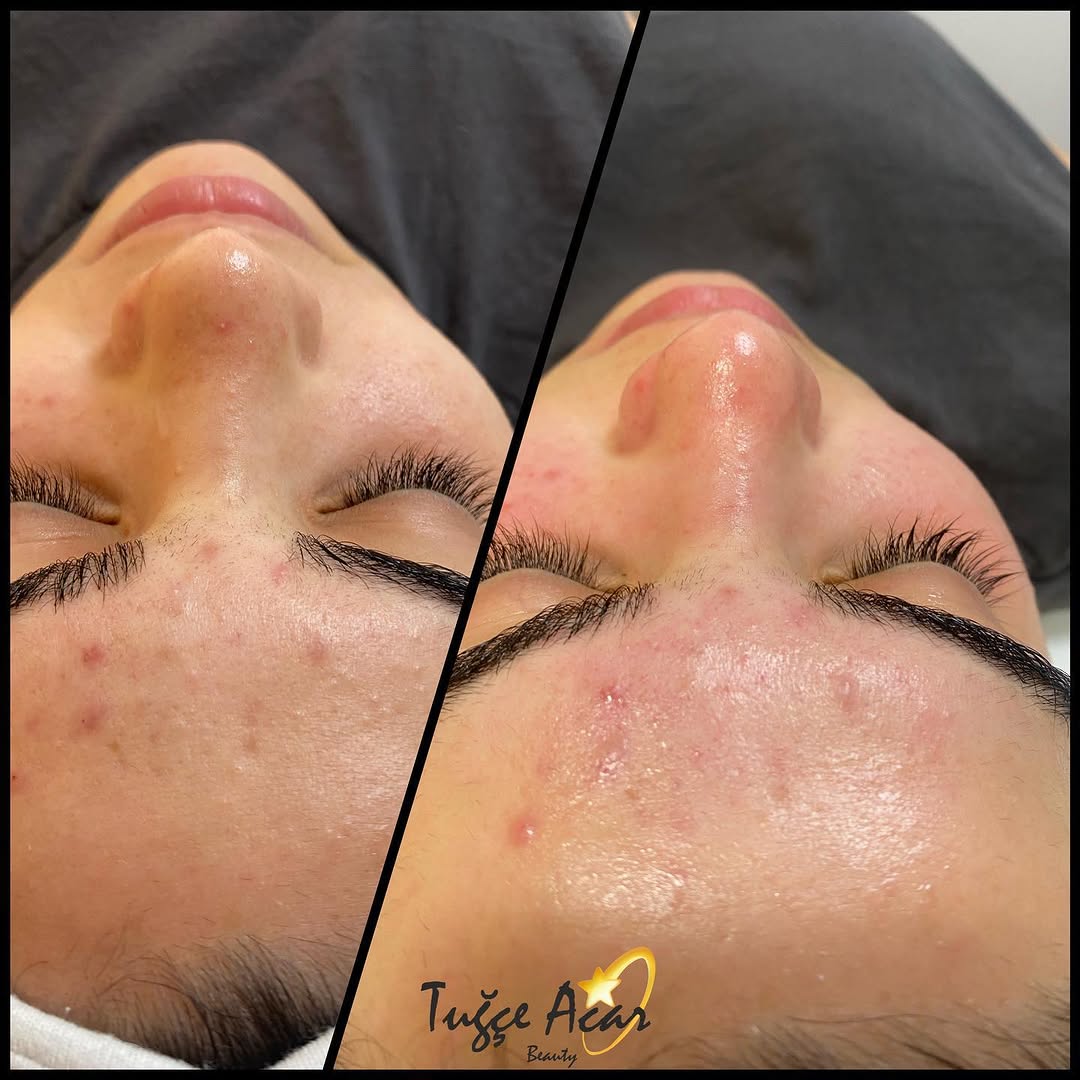 Hydrafacial in Antalya: The Secret to Glass Skin