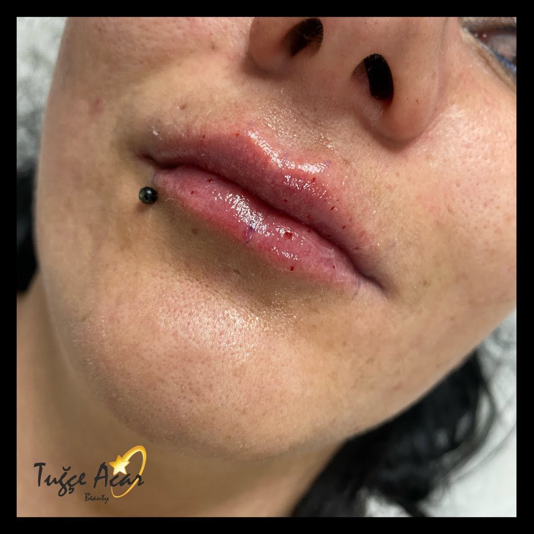 Lip Blush vs Old-Style Lip Tattoo: Modern Approach in Antalya