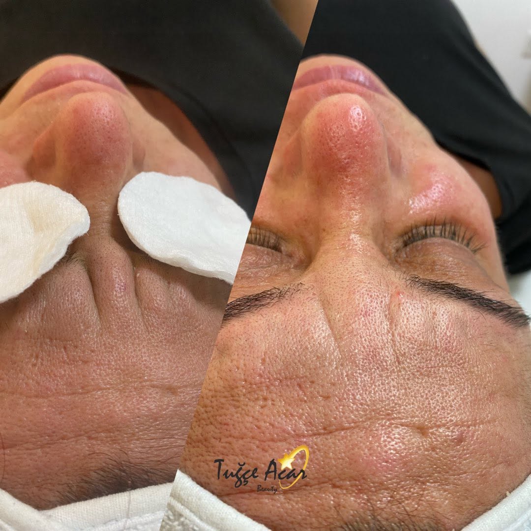 Summer Skincare in Antalya: Sun Protection and Restoration Routine