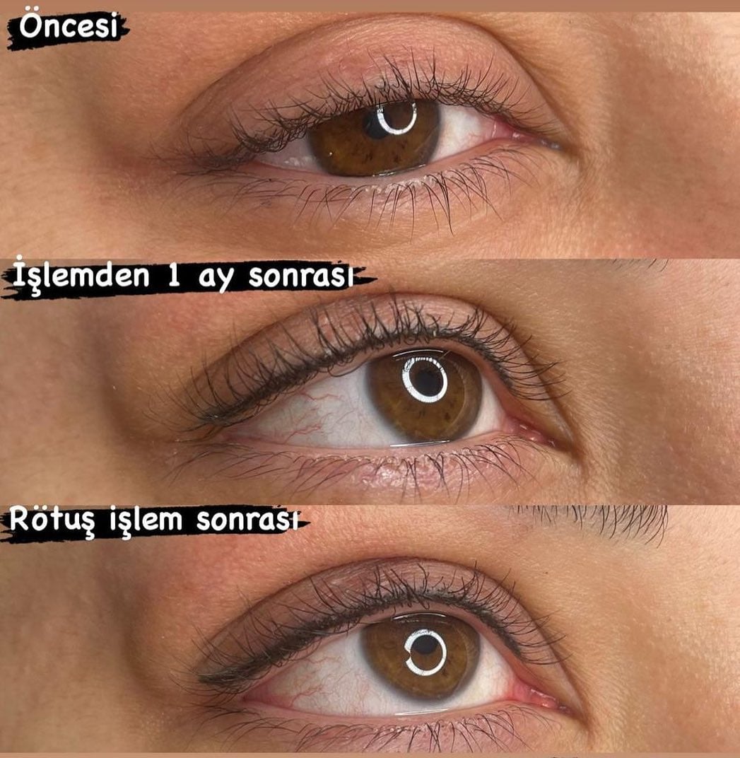 Permanent Eyeliner (Lash Liner) in Antalya: Adding Depth to Your Gaze