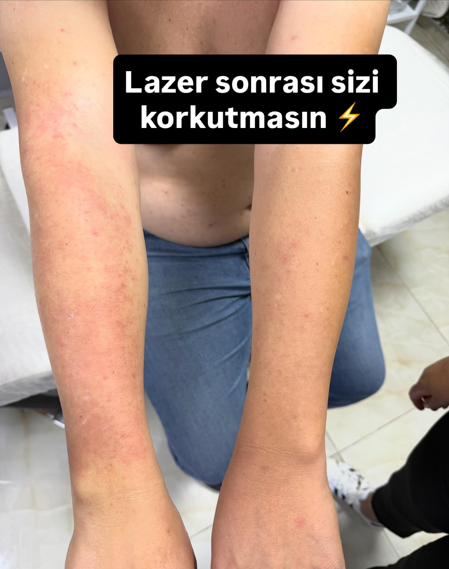 Lazer sonrası sizi korkutmasın ⚡ Hafif kızarıklık normal — soğuk uygulama ve nemlendirme önemli.